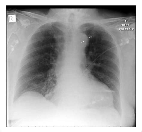 Aortic Calcification On Chest X Ray