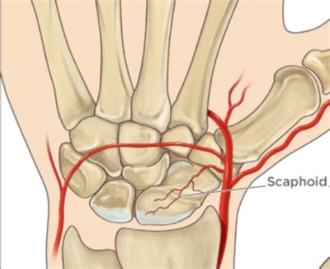 Scaphoid Fractures Canberra Hand Centre