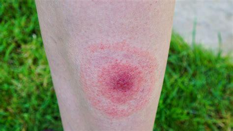What Does A Tick Bite Look Like Health