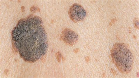 Seborrheic Keratosis Lp Clinic