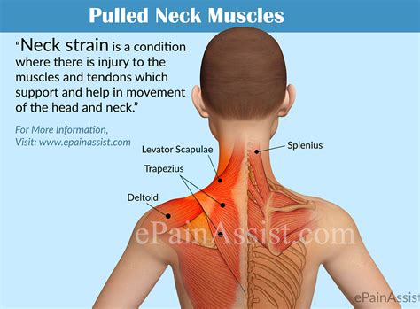 Pulled Neck Muscle Or Neck Straincausessymptomstreatmentdiagnosis