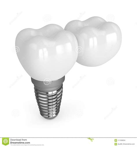 3d Render Of Implant With Dental Cantilever Bridge Stock