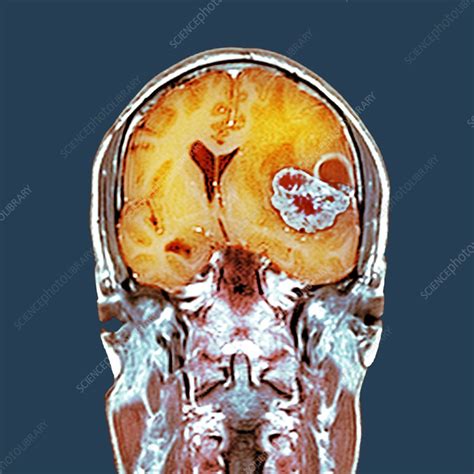 Brain Cancer Mri Scan Stock Image C0164436 Science Photo Library