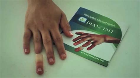 Aesthetic Finger Prostheses No Youtube