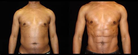Ab Etching For Men Dr N Lahouel