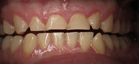 Children often grind their teeth in sleep. Teeth Grinding - United Dentist