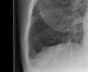 They can be an evanescent sign on the cxr of a patient in and out of heart failure. Septal lines in lung | Radiology Reference Article ...