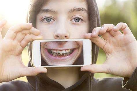 How Are Braces Put On Learn The Basics Of The Brackets