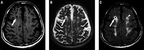 Scielo Brasil Neuroimaging In Cerebral Small Vessel Disease Update