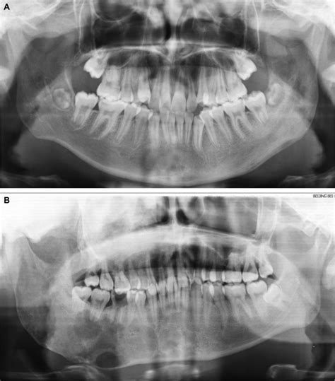 Comparing Clinical And Radiographic Characteristics Of Chronic Diffuse