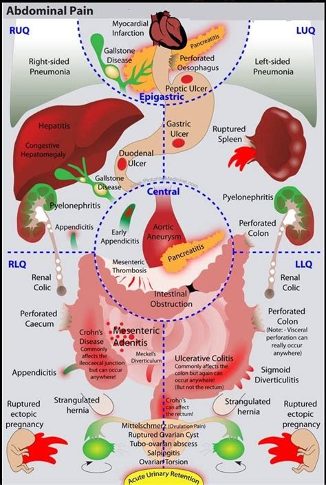 Causes Of Abdominal Pain An Illustrated Differential