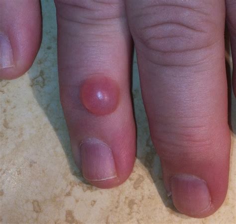 Mucous Cysts Of The Fingers Orthogate