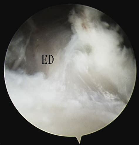Endoscopic Decompression Of A Gouty Tophus At The Hand Dorsum