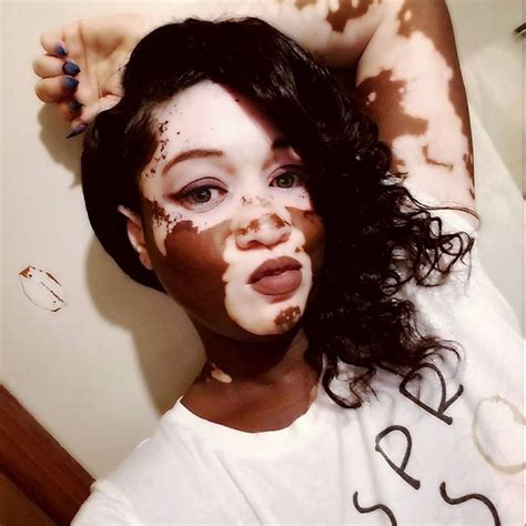 Pin By Hunnee Bijoux On The Beauty Of Vitiligo Pretty People