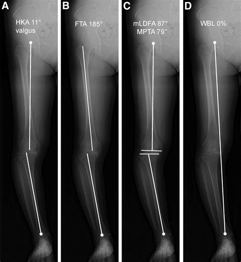 Inverted Vshaped High Tibial Osteotomy For Medial Osteoarthritic Knees