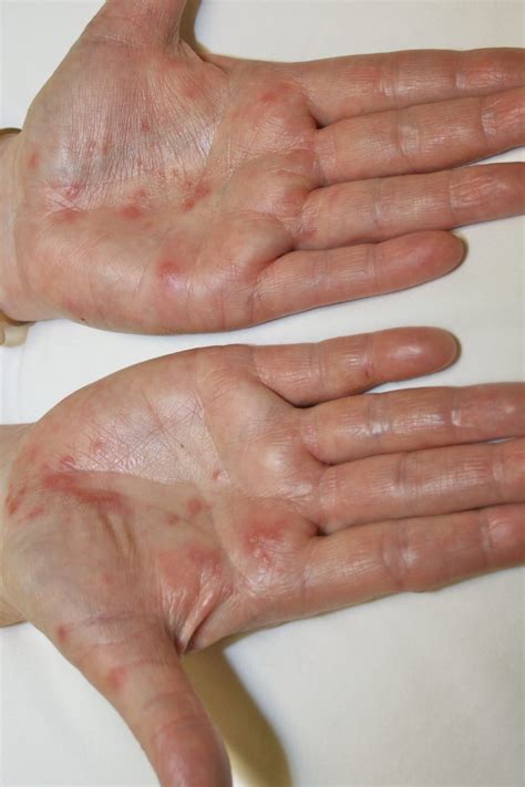 Types Of Eczema On Hands And Feet Dorothee Padraig South West Skin