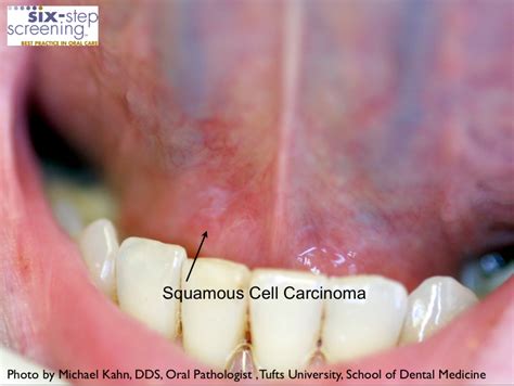 Is It Oral Cancer Six Step Screening