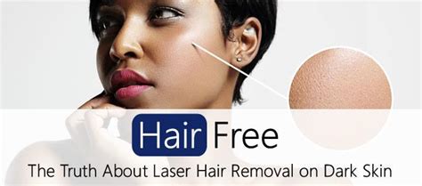 42 Yag Laser Hair Removal For Dark Skin At Home Rhisteunis