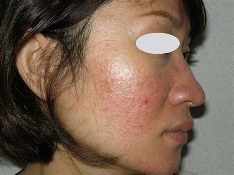 Virtual Grand Rounds In Dermatology 20 Facial Flush In A Pregnant Woman