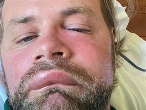 Waterford News Star Brian McFadden Suffers Severe Allergic Reaction