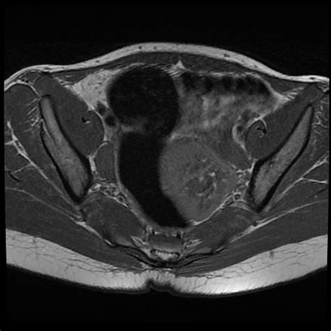 Mayer Rokitansky Küster Hauser Syndrome Mrkh With A Tailgut Cyst