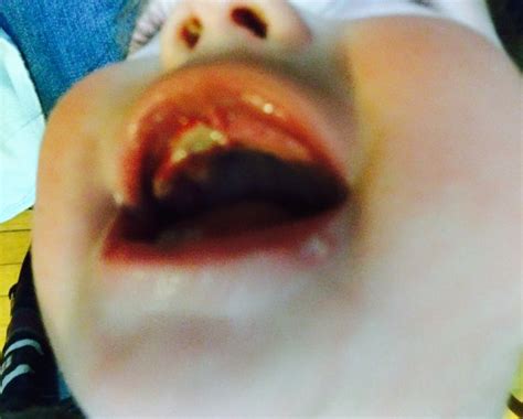 Btdt Help Baby Gums Infected Is This Normal For Teething