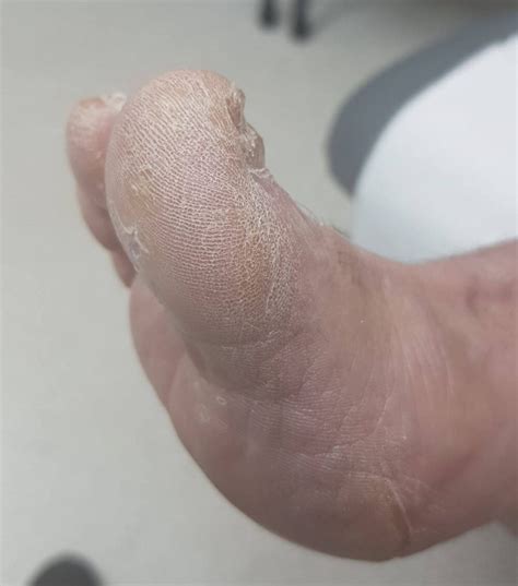 Itchy Foot Blisters Could Your Blisters Be Fungal Blister Prevention