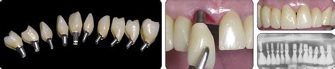 Bicon Dental Implants Placement And Restorations