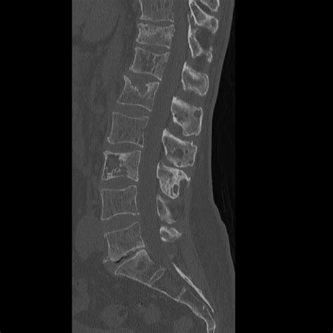 Multiple Sclerosis Spinal Cord Mri Radiopaedia