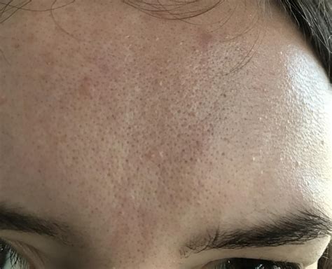 Orange Peel Skin Disaster W Pictures General Acne Discussion Acne