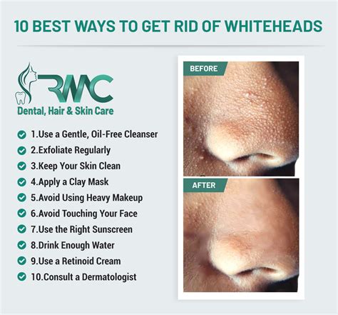 10 Ways To Get Rid Of Whiteheads Rehman Medical Center