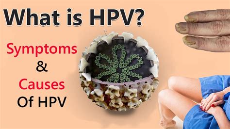 Human Papillomavirus Infection Symptoms And Causes Of Hpv Youtube