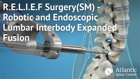 Relief Surgery Sm Robotic And Endoscopic Lumbar Interbody