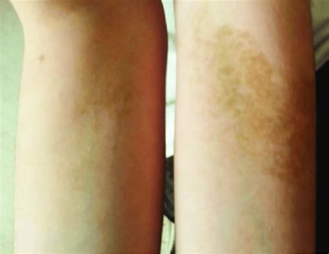 Brownish Plaques On The Forearms In An 11 Year Old Boy Download