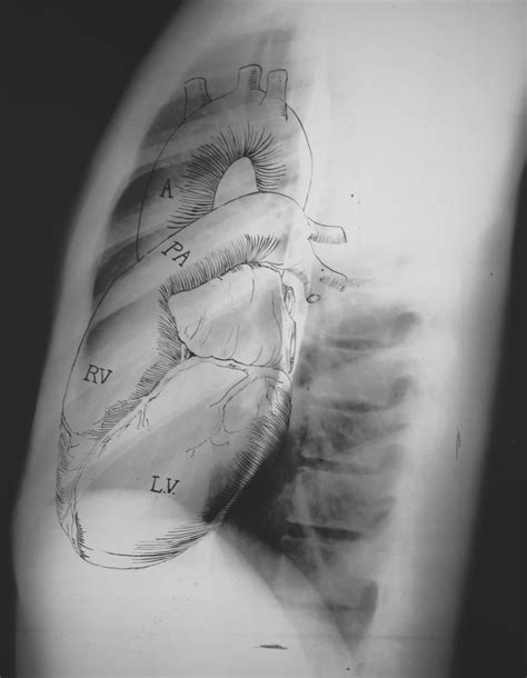 Normal Chest X Ray Litfl Medical Blog Labelled Radiology