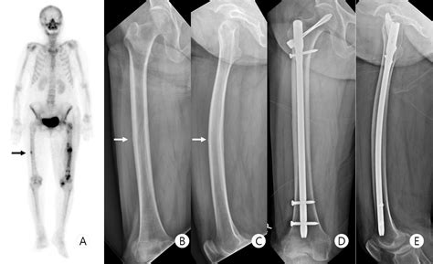 Cureus Secondary Subtrochanteric Fracture After Atypical Femoral