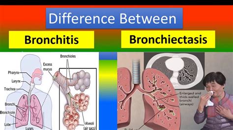 Difference Between Bronchitis And Bronchiectasis Youtube