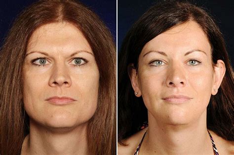 Facial Feminization Surgery Lipofilling Feminizing The Face With