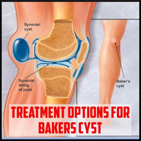 Investigaciones Metabolicas View 16 Baker S Cyst Rupture Treatment
