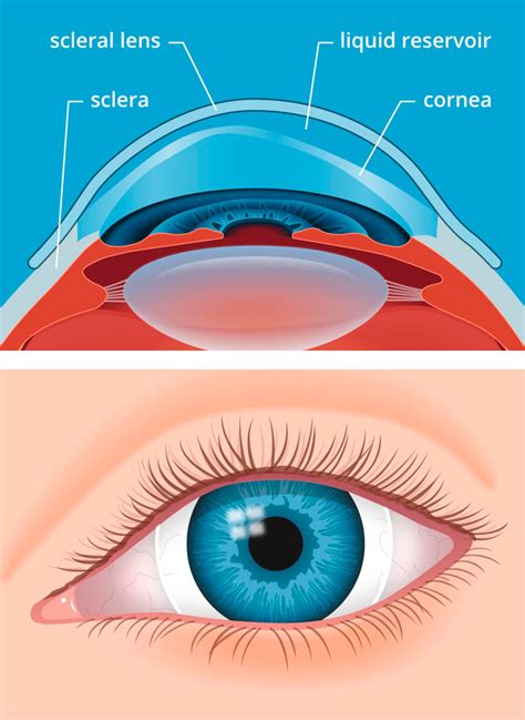 Keratoconus And Specialty Lenses Roswell Eye Clinic