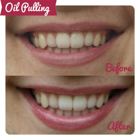 Oil How To Oil Pulling
