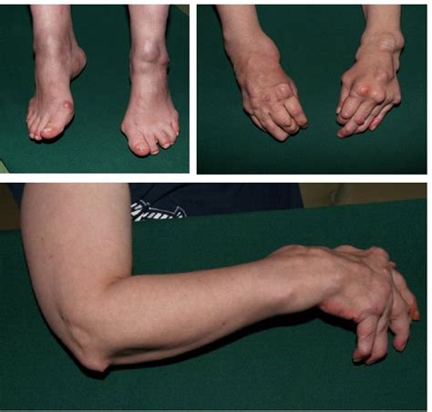 Get Stages Of Rheumatoid Arthritis Hands Background Propranolols