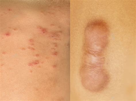 Keloid Vs Irritation Bump Understanding The Differences And How To Treat Them