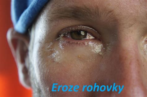 Eroze Rohovky Příznaky Projevy Symptomy Příčina Léčba Fotografie