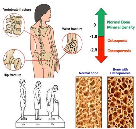 Osteoporosis Causes Features Prevention And Treatment Medchrome