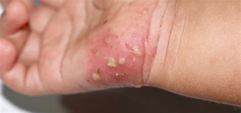 Scabies Dermatology And Skin Health Dr Mendese