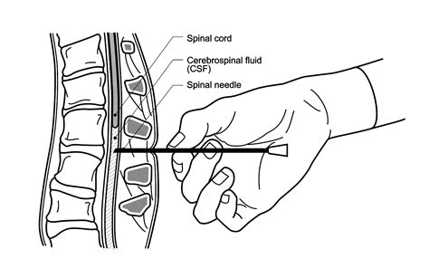 Lumbar Puncture Needle Types