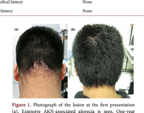 Pdf Surgical Treatment Of Scarring Alopecia Associated With Acne