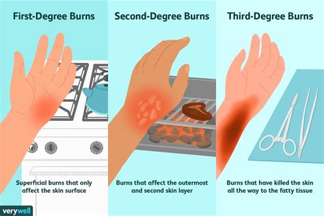 Download in under 30 seconds. How Different Degrees of Burns Are Treated