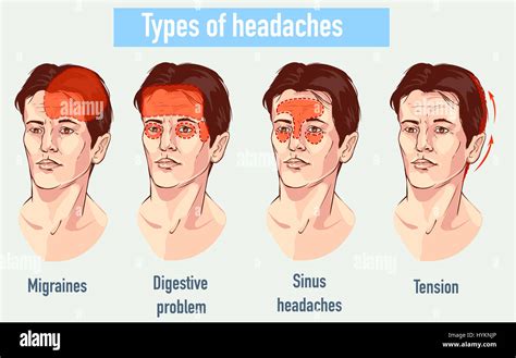 Illustration About Headaches 4 Type On Different Area Of Patient Head
